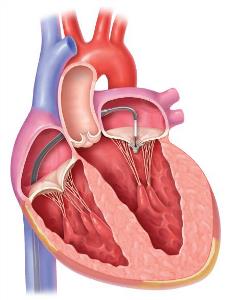 Mitral Valve side-view